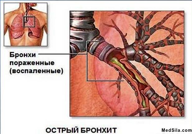 Пораженные бронхи